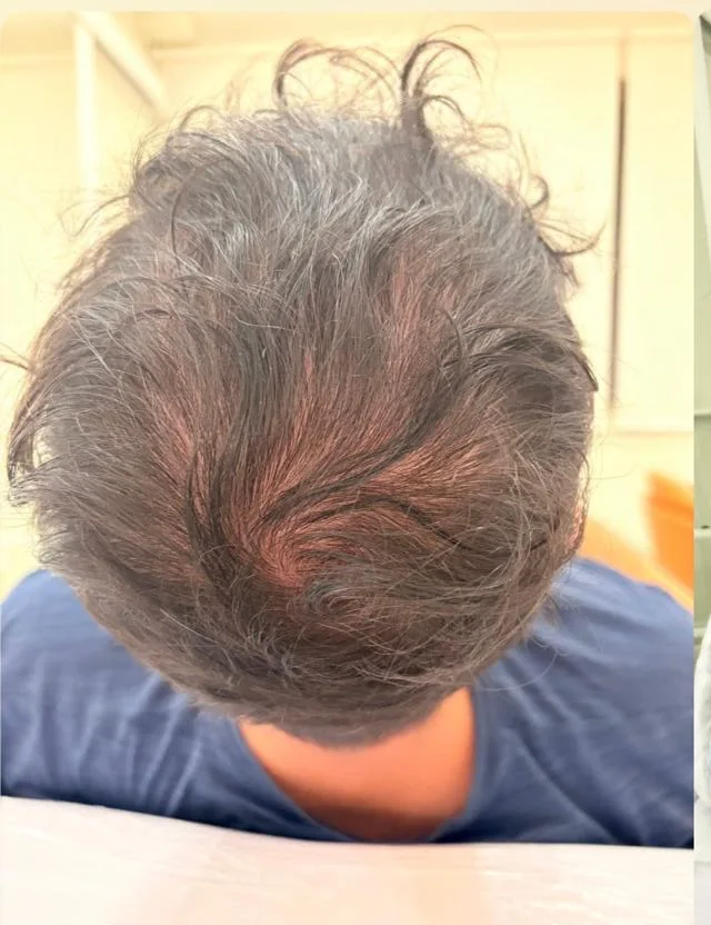 Couro cabeludo antes do tratamento, com rarefação e couro à mostra