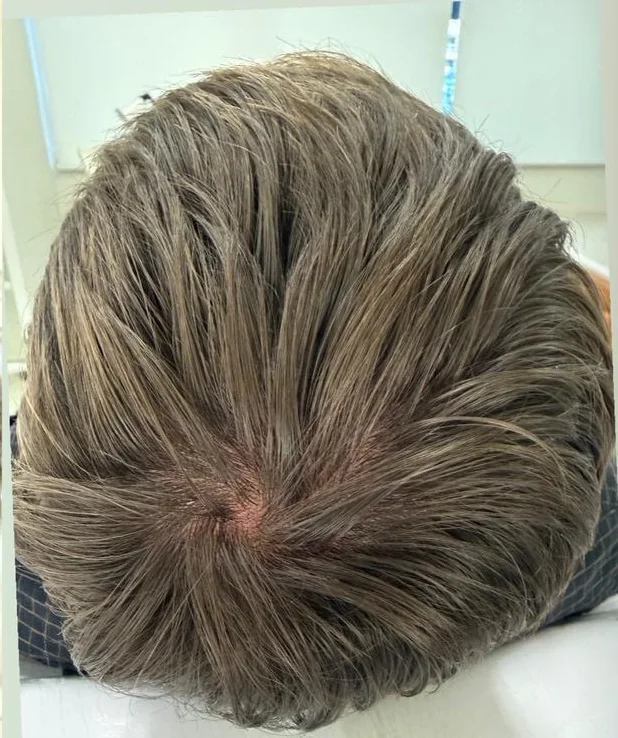 Coroa antes do tratamento, com menos densidade e couro mais aparente
